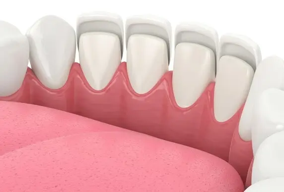 Dental Veneers