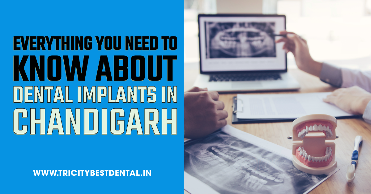 Everything You Need to Know About Dental Implants in Chandigarh