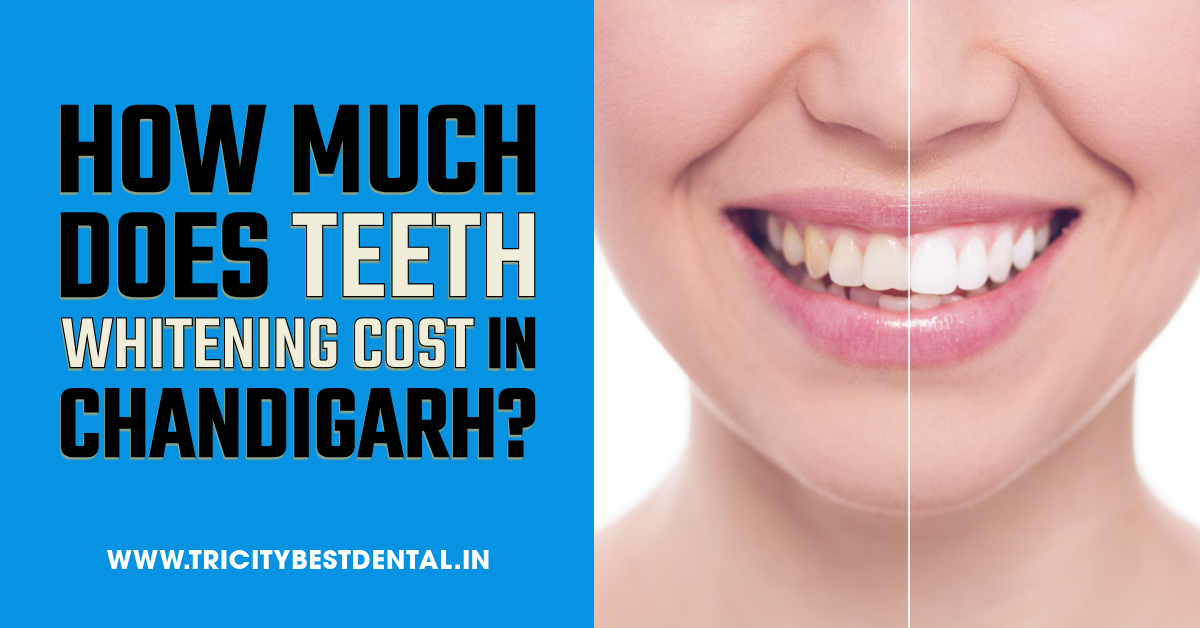 How Much Does Teeth Whitening Cost in Chandigarh