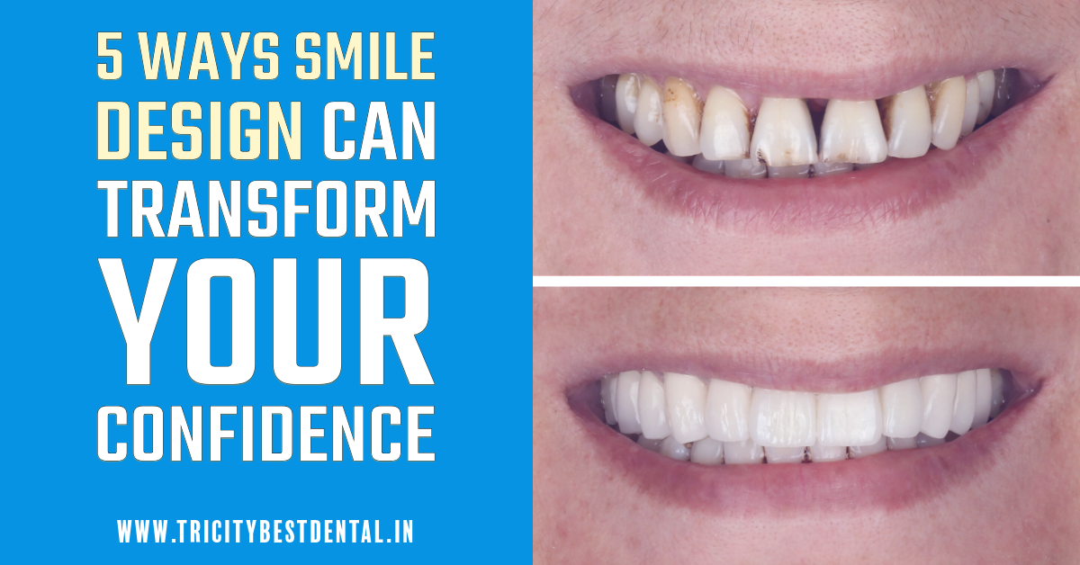 5 Ways Smile Design Can Transform Your Confidence