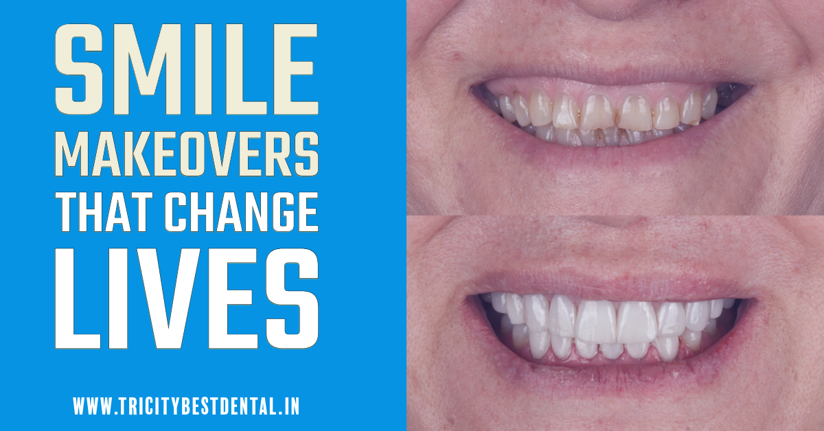 Smile Makeovers That Change Lives