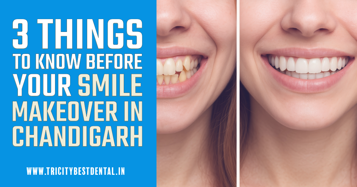 3 Things to Know Before Your Smile Makeover in Chandigarh