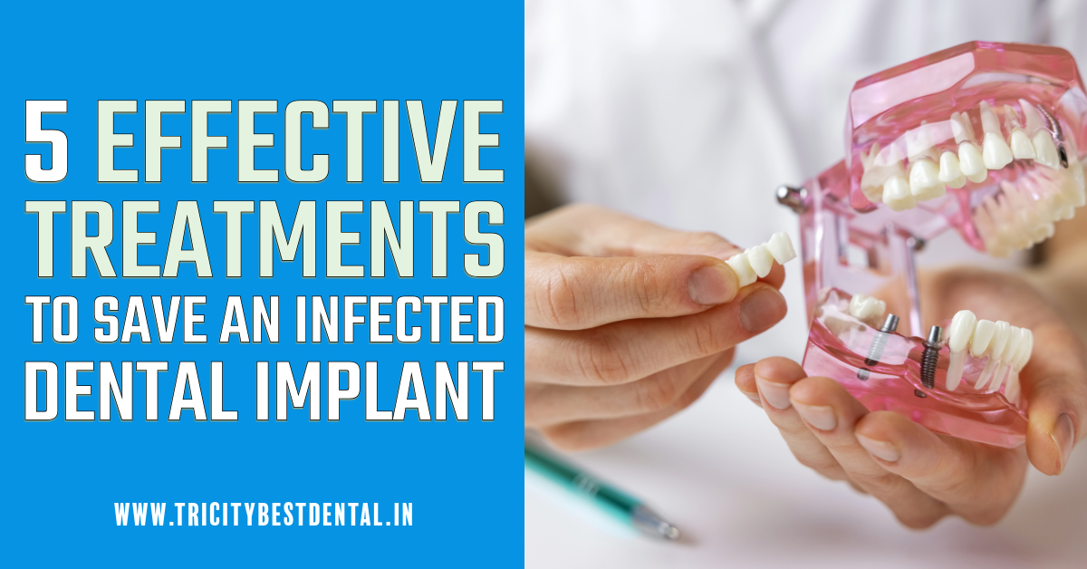 5 Effective Treatments to Save an Infected Dental Implant
