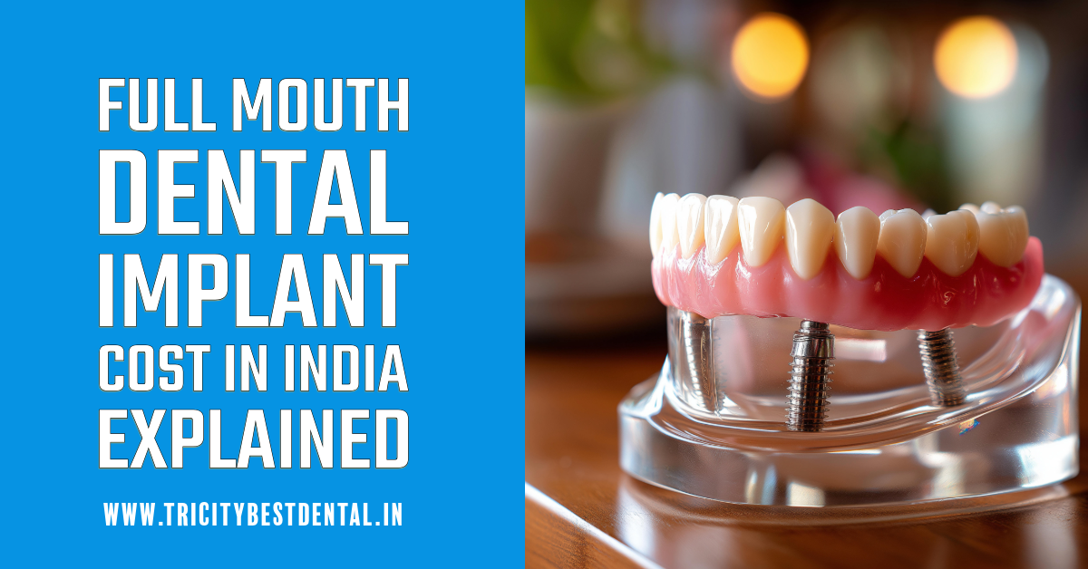 Full Mouth Dental Implant Cost in India Explained