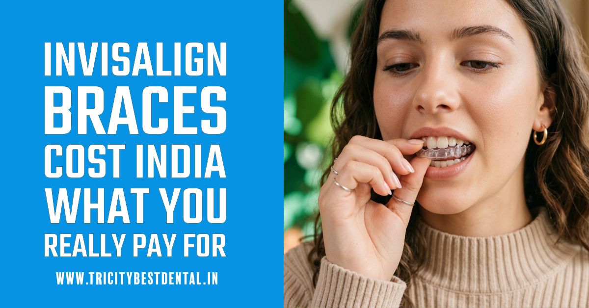Invisalign Braces Cost India - What You Really Pay For