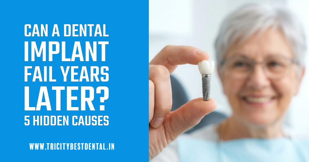 Can a Dental Implant Fail Years Later 5 Hidden Causes