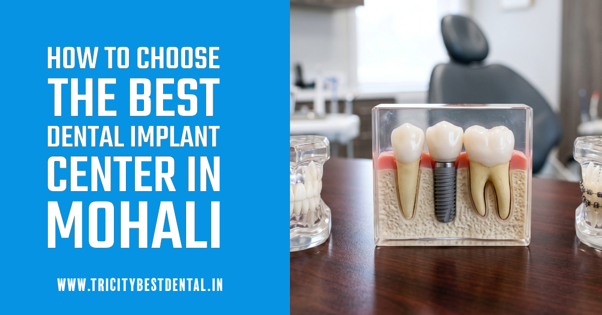 How to Choose the Best Dental Implant Center in Mohali