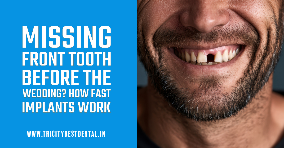Missing Front Tooth Before the Wedding How Fast Implants Work